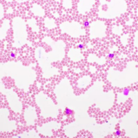 Tissue specimen stained with Astral Diagnostics Wright-Giemsa