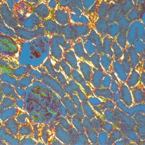 PSR Kidney